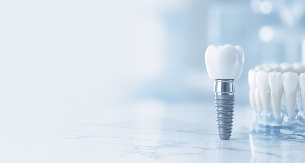Blog Implantes Dentales en Cordón, Montevideo - Odontoplace