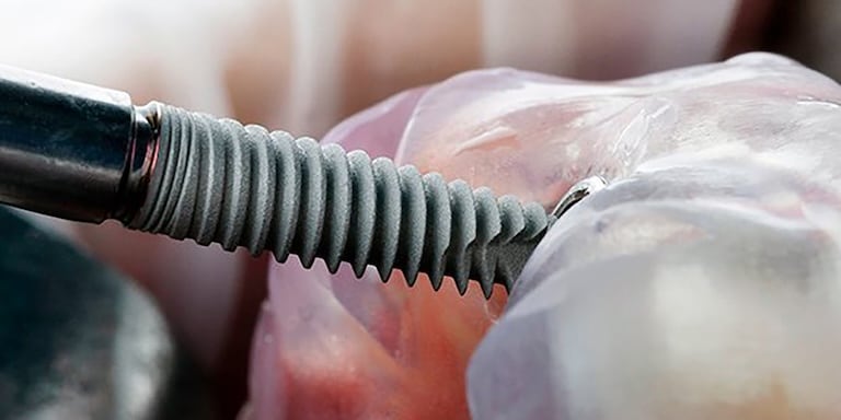 Odontoplace Implantes Dentales en Cordón, Montevideo - Odontoplace