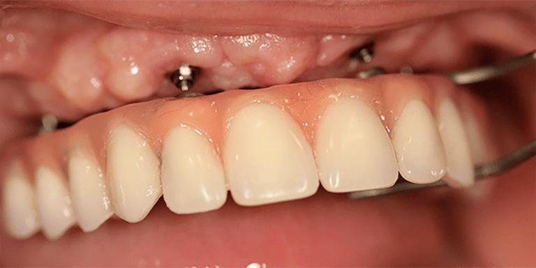 Odontoplace Protesis Restauraciones Fijas en Cordón, Montevideo - Odontoplace